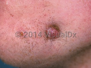 Clinical image of Cutaneous dental sinus tract - imageId=423132. Click to open in gallery.  caption: 'A reddish nodule with scant overlying scale and surrounding crusting, and a similar papule, on the lateral chin.'