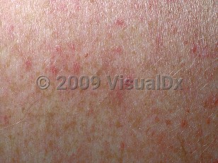 Clinical image of Dengue fever