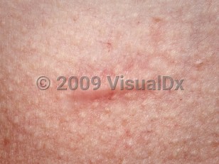 Clinical image of Scar - imageId=4235247. Click to open in gallery.  caption: 'A close-up of a hypertrophic scar, appearing as a linear shiny plaque.'