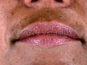 Clinical image of Melasma - imageId=425827. Click to open in gallery.  caption: 'An evenly pigmented tan patch on the upper cutaneous lip.'