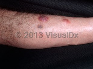 Clinical image of Mycobacterium chelonae infection