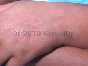 Clinical image of Scarlet fever - imageId=426336. Click to open in gallery.  caption: 'Patchy erythema on the hand and wrist.'
