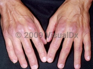 Clinical image of Rheumatoid arthritis - imageId=4267555. Click to open in gallery.  caption: 'Violaceous patches over the Metacarpophalangeals (MCP) and dorsal fingers in a patient with morphea. '