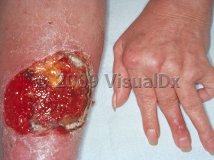 Clinical image of Felty syndrome - imageId=4327488. Click to open in gallery.  caption: 'A large ulcer with overlying granulation tissue on the leg and typical hand and finger joint deformities of rheumatoid arthritis.'
