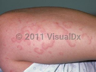 Clinical image of Urticarial vasculitis