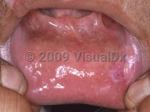 Clinical image of Oral lupus erythematosus - imageId=4347200. Click to open in gallery.  caption: 'Whitish and reddish prlaques on the labial mucosa.'