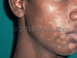 Clinical image of Post kala azar dermal leishmaniasis - imageId=4357184. Click to open in gallery.  caption: 'Numerous hypopigmented macules, papules, and plaques on the face.'