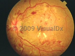 Clinical image of Diabetic retinopathy