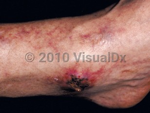 Clinical image of Cryoglobulinemia - imageId=43785. Click to open in gallery.  caption: 'Purpuric macules on the leg and an eschar overlying a purpuric plaque on the ankle.'