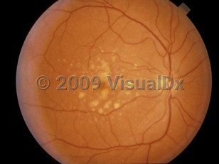 Clinical image of Age-related macular degeneration - imageId=4378880. Click to open in gallery. 