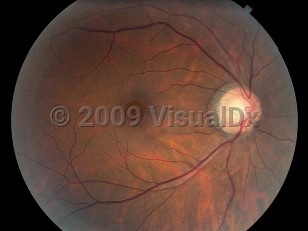 Clinical image of Macular hole - imageId=4380541. Click to open in gallery. 