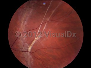 Clinical image of Retinal detachment