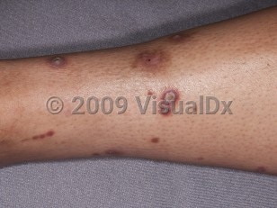 Clinical image of Chronic kidney disease - imageId=4388096. Click to open in gallery.  caption: 'Several hyperpigmented and keratotic papules on the leg, in a patient on dialysis.'