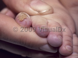 Clinical image of Richner-Hanhart syndrome - imageId=4404111. Click to open in gallery. 