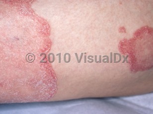Clinical image of Pustular psoriasis - imageId=4406336. Click to open in gallery.  caption: 'A close-up of well-demarcated, erythematous plaques with peripherally accentuated scale.'