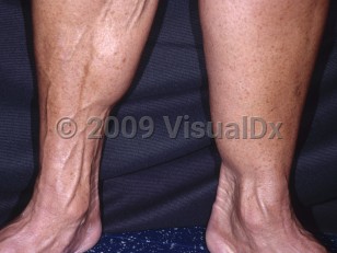Clinical image of Lipoatrophy - imageId=4420916. Click to open in gallery.  caption: 'Loss of girth of the right leg, secondary to lipoatrophy.'