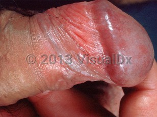 Clinical image of Bowenoid papulosis