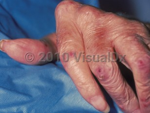 Clinical image of Rheumatoid vasculitis - imageId=44401. Click to open in gallery.  caption: 'Purpuric papules and crusting with surrounding pink erythema on the thumb and fingers.'