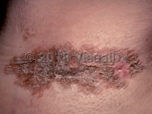 Clinical image of Granular parakeratosis - imageId=4468158. Click to open in gallery.  caption: 'A brownish plaque with brown keratotic projections in the axilla.'