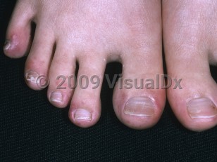 Clinical image of Cryofibrinogenemia - imageId=4477923. Click to open in gallery.  caption: 'Erythematous and purpuric papules and plaques on the distal toes of a patient with lupus.'