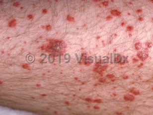 Clinical image of Immunoglobulin A vasculitis - imageId=45124. Click to open in gallery.  caption: 'A close-up of many purpuric macules and papules, some with central vesiculation.'