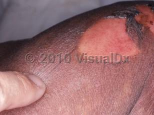 Clinical image of Toxic epidermal necrolysis