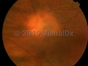 Clinical image of Choroidal nevus