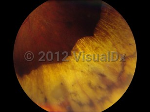 Clinical image of Retinopathy of prematurity - imageId=4538015. Click to open in gallery. 