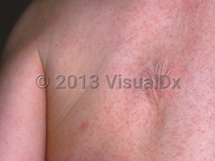 Clinical image of Fibrous hamartoma of infancy - imageId=457780. Click to open in gallery.  caption: 'A hypertrichotic patch on the back. Note also the unrelated erythematous papules (possible miliaria rubra).'