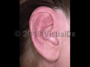 Clinical image of Relapsing polychondritis - imageId=4580899. Click to open in gallery.  caption: 'Diffuse pink erythema of the ear, sparing the ear lobule.'