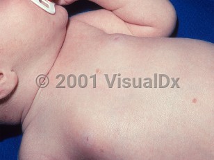 Clinical image of Congenital self-healing histiocytosis - imageId=458167. Click to open in gallery.  caption: 'Two pinkish papules on the trunk of an infant.'