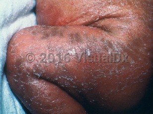Clinical image of Conradi disease