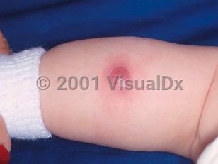 Clinical image of Chronic granulomatous disease - imageId=459553. Click to open in gallery.  caption: 'A deep pink nodule with surrounding erythema on the leg.'
