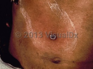 Clinical image of Bubonic plague - imageId=462254. Click to open in gallery.  caption: 'An umbilicated bulla with central crusting and surrounding erythema on the abdomen.'