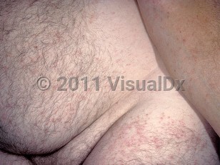 Clinical image of Ehrlichiosis - imageId=462527. Click to open in gallery.  caption: 'Widespread erythematous and purpuric macules and papules on the trunk, arm, and leg.'