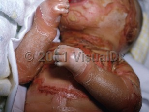 Clinical image of Harlequin ichthyosis