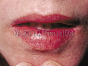 Clinical image of Hereditary hemorrhagic telangiectasia - imageId=46847. Click to open in gallery.  caption: 'Bright red macules and papules on the lips.'
