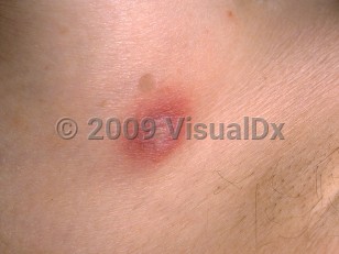 Clinical image of Ecthyma gangrenosum - imageId=47238. Click to open in gallery.  caption: 'A close-up of an erythematous plaque with a central overlying bulla.'