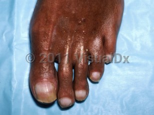 Clinical image of Half and half nail syndrome - imageId=4741119. Click to open in gallery.  caption: 'Pale proximal portions of toenails with light brown distal portions.'