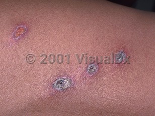Clinical image of Histoplasmosis - imageId=475939. Click to open in gallery.  caption: 'Eroded and crusted plaques on the arm of a patient with AIDS.'