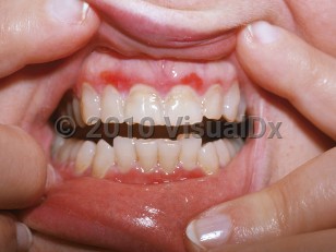 Clinical image of Desquamative gingivitis - imageId=4762688. Click to open in gallery. 