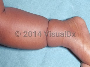 Clinical image of Constriction ring syndrome - imageId=4765439. Click to open in gallery.  caption: 'A deep constriction band around the lower leg.'