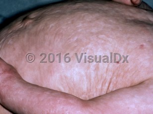 Clinical image of Congenital erosive and vesicular dermatosis