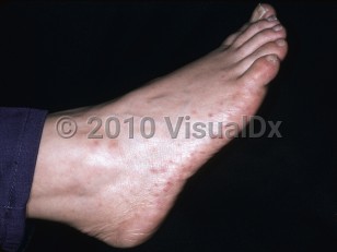 Clinical image of Atrial myxoma - imageId=4766940. Click to open in gallery.  caption: 'Violaceous discoloration of the toes and purpuric papules on the foot.'