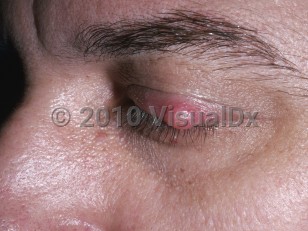 Clinical image of Hordeolum and chalazion - imageId=4768064. Click to open in gallery.  caption: 'A brightly erythematous and somewhat yellowish nodule on the upper eyelid.'