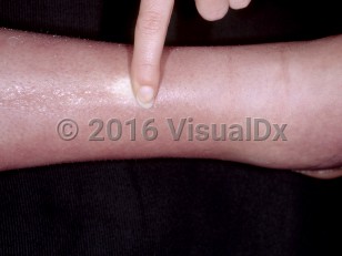Clinical image of Familial Mediterranean fever - imageId=4770313. Click to open in gallery.  caption: 'Edema and blanching erythema of the shin.'