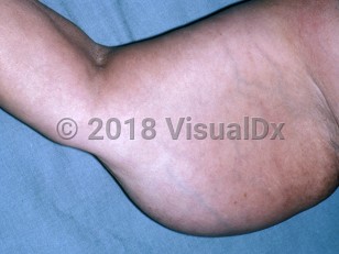 Clinical image of Adiposis dolorosa - imageId=4770864. Click to open in gallery.  caption: 'A large subcutaneous tumor on the upper arm.'