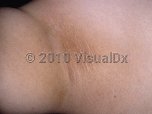 Clinical image of Alstrom syndrome - imageId=4772998. Click to open in gallery.  caption: 'Velvety plaques (acanthosis nigricans) in the axilla.'