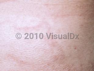 Clinical image of Mid-dermal elastolysis