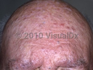 Clinical image of Brooke-Spiegler syndrome - imageId=4773757. Click to open in gallery.  caption: 'Numerous reddish and violaceous papules on the forehead.'
